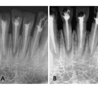 Root canal treatment